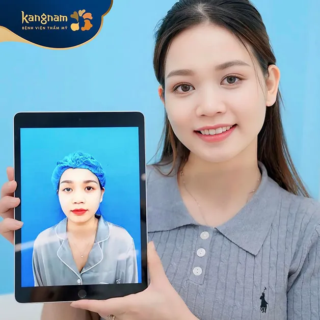 Thiết kế nếp mí phù hợp với từng khách hàng