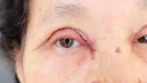 Cắt mí hỏng là gì? Dấu hiệu nhận biết, nguyên nhân và hướng xử lý