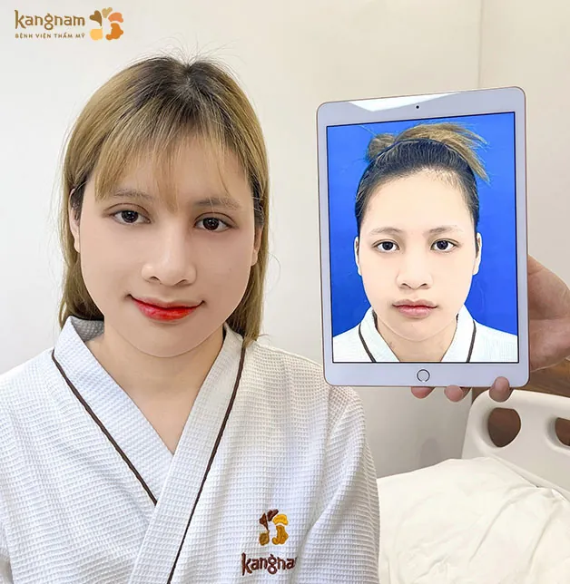 Cắt mí 6D