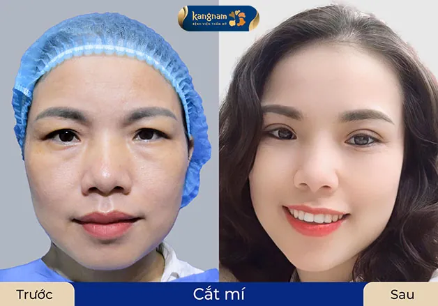 Cải thiện tầm nhìn sau khi cắt mí