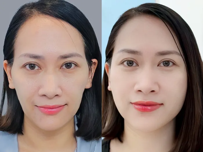 Chi phí cấy mỡ phụ thuộc vào vị trí cấy mỡ