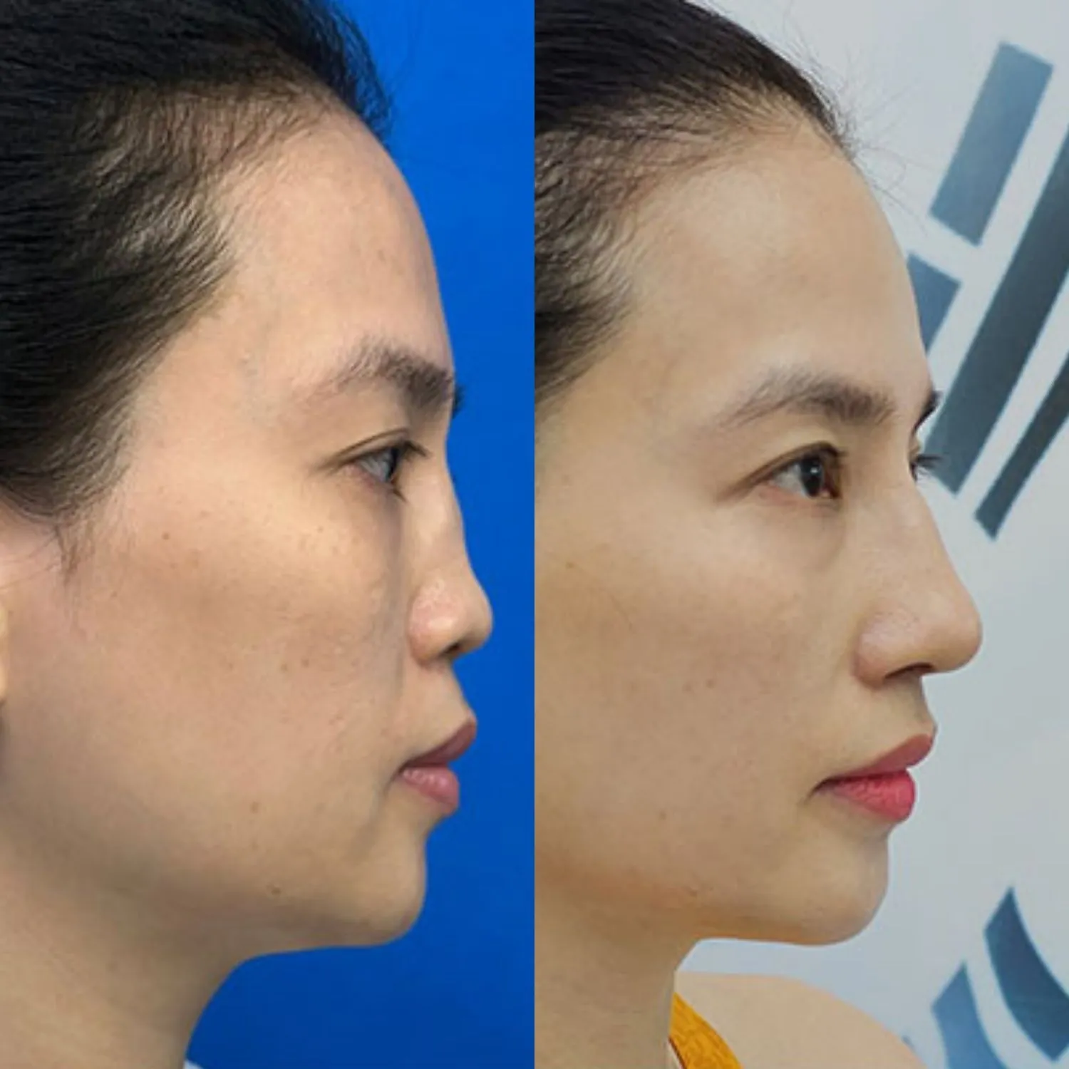 Giải cứu mũi lỗi, hỏng thành công