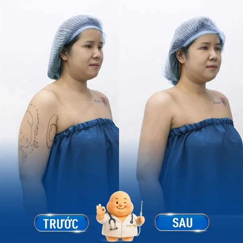 Loại bỏ mỡ bắp tay chỉ trong tíc tắc
