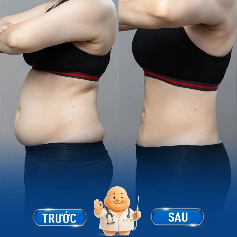 Tống khứ mỡ bụng khổng lồ chỉ sau 1 lần thực hiện