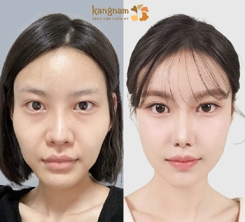 Nên hạ gò má khi gương mặt không cân đối, gò má cao
