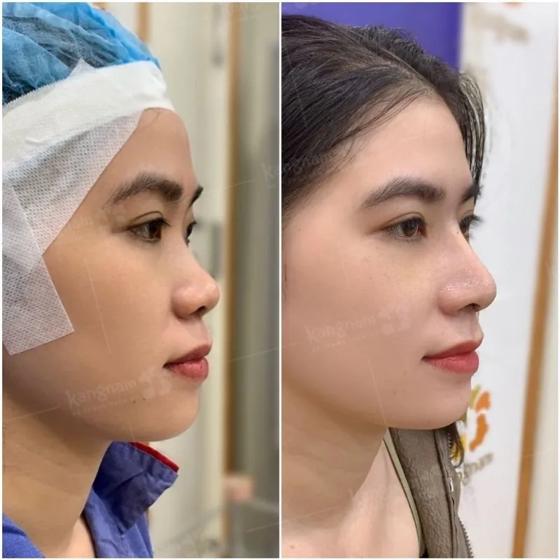 Mũi tự nhiên, cân đối không bị giả hay thô cứng