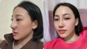 Làm mũi có nguy hiểm không