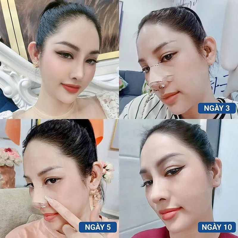 Quá trình gom form mũi thực tế sau 7 ngày nâng mũi 