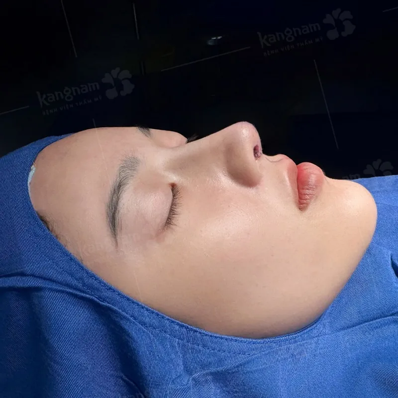 dáng mũi sau phẫu thuật được chỉnh sửa toàn diện từ sống mũi, đầu mũi, cánh mũi, trụ mũi