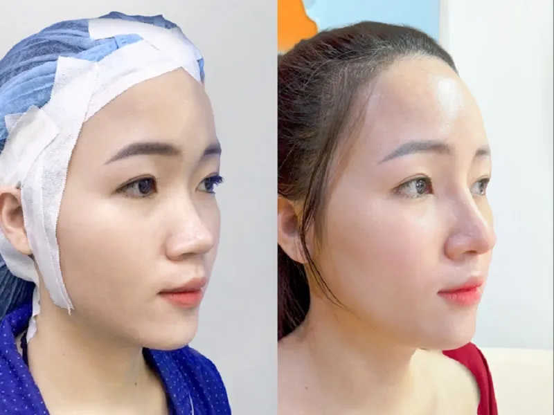 khách hàng trước và sau khi nâng mũi cấu trúc kết hợp sụn tự thân, đầu mũi tự nhiên và hạn chế bóng đỏ