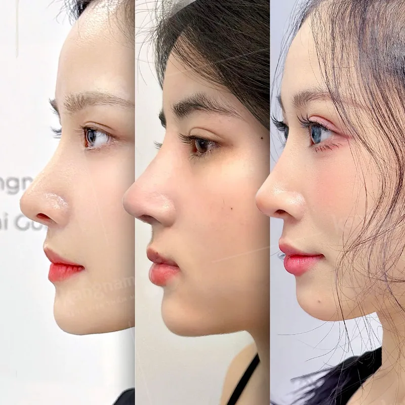 Nâng mũi giúp cải thiện khuyết điểm, dáng mũi trông tự nhiên hơn