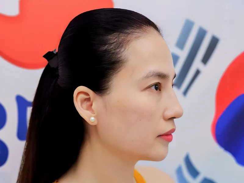 Khách hàng mũi hỏng sau khi tái tạo bằng sụn sườn sở hữu dáng mũi ổn định, không bị cong vênh, lệch sụn