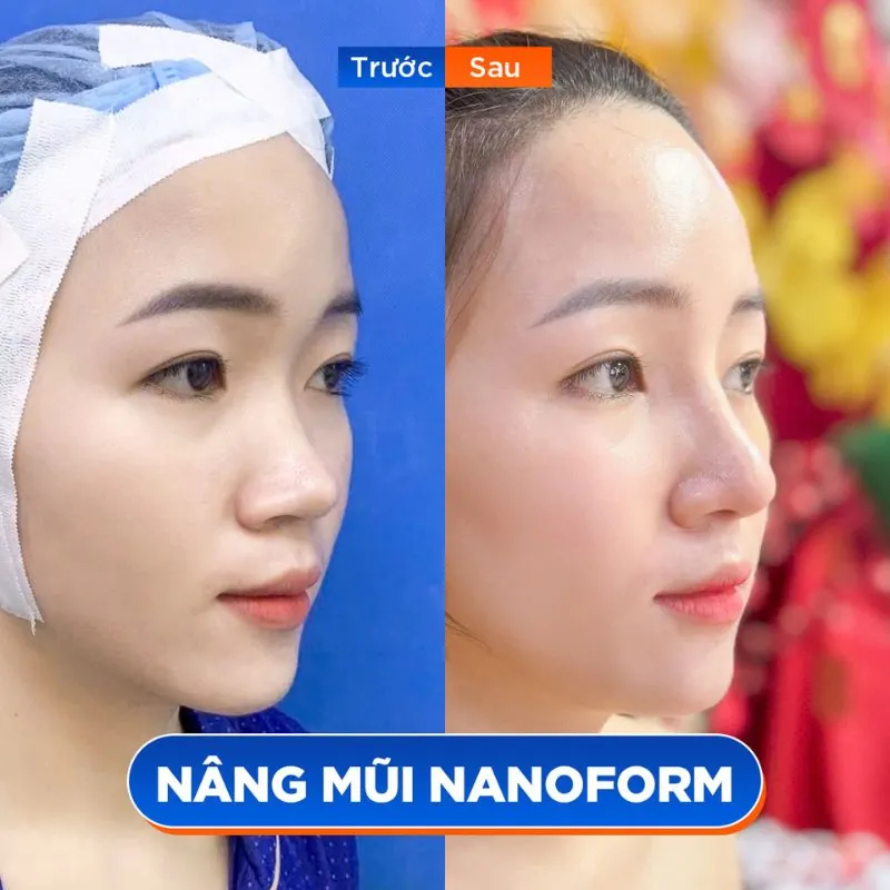Form mũi tự nhiên, cao vừa phải