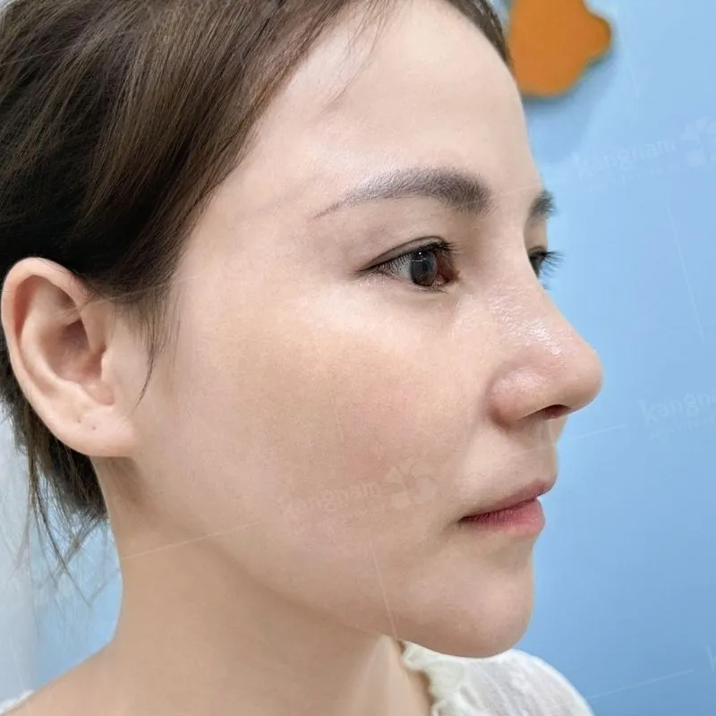 Lỗ mũi hạt chanh cân đối chuẩn tỷ lệ vàng khi nâng mũi