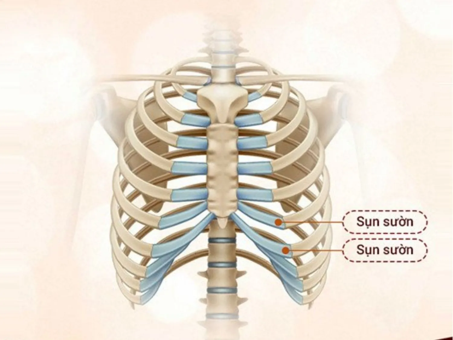 ảnh mô phỏng Sụn sườn được lấy ở vị trí các thanh xương sườn số 6, 7 hoặc 8