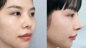 So sánh các phương pháp nâng mũi