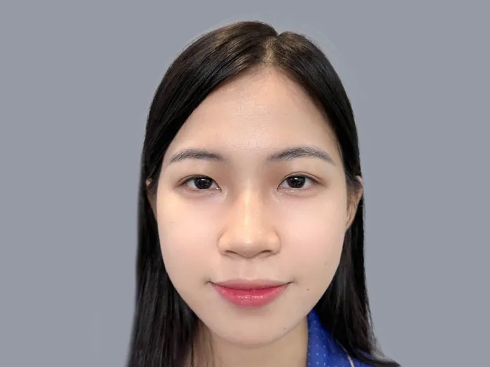 tình trạng khách hàng mít lót, 2 bên mí không đều rất phù hợp để cắt mí plasma