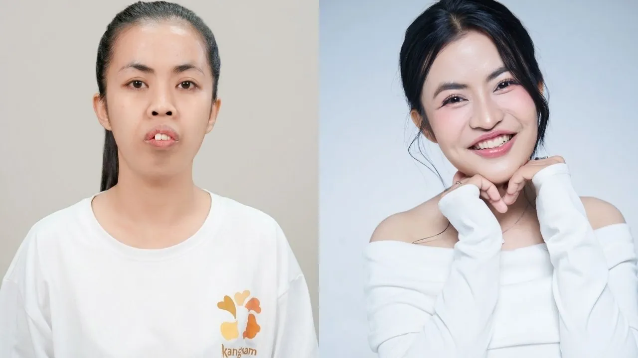 Ảnh so sánh trước và sau khi cắt mí Plasma của Trương Thị Trà My (24 tuổi). Hình ảnh bên trái cho thấy đôi mắt một mí, nếp mí không đều, hơi sụp khiến gương mặt trông mệt mỏi.