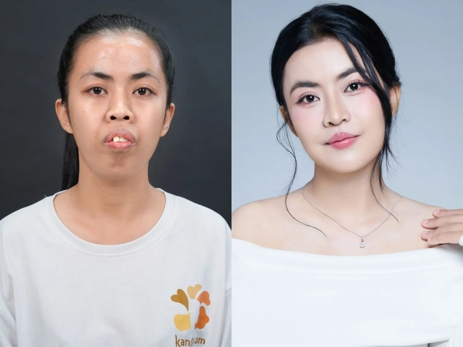 ảnh trước và sau khi cắt mí, chỉnh hàm, nâng mũi, cấy mỡ của trà my