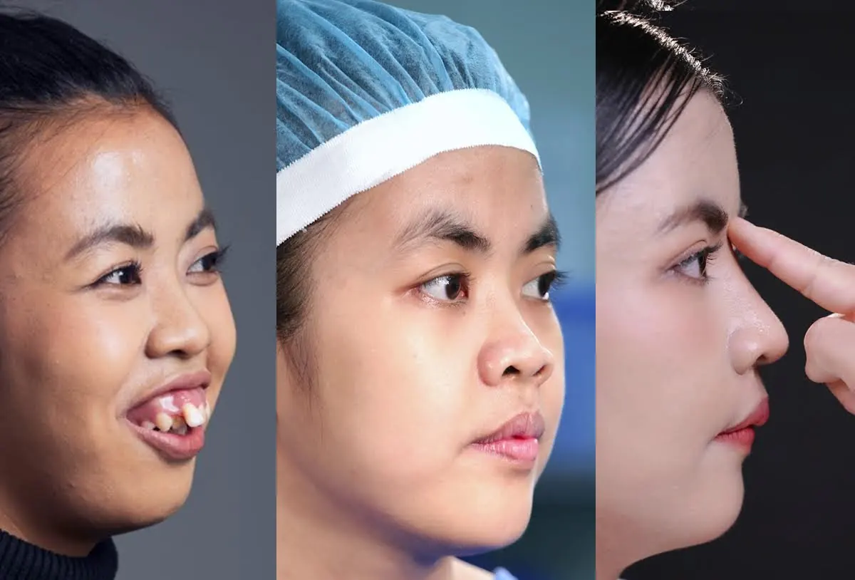 Võ Trần Bảo Ngọc và hành trình thay đổi dáng mũi, sống mũi cao, thon và đẹp hơn sau phẫu thuật