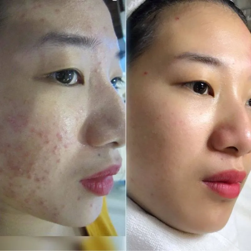 Cải thiện tất cả tình trạng mụn
