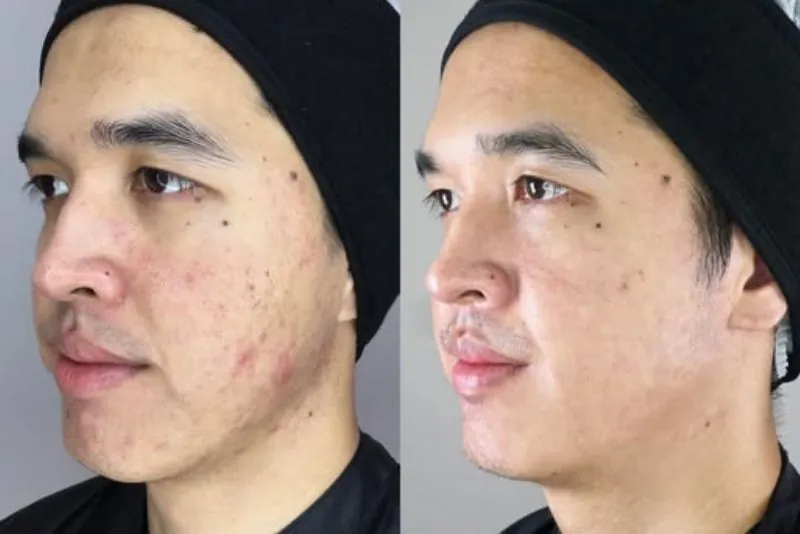 Phác đồ trị mụn cá nhân hóa, an toàn cho da