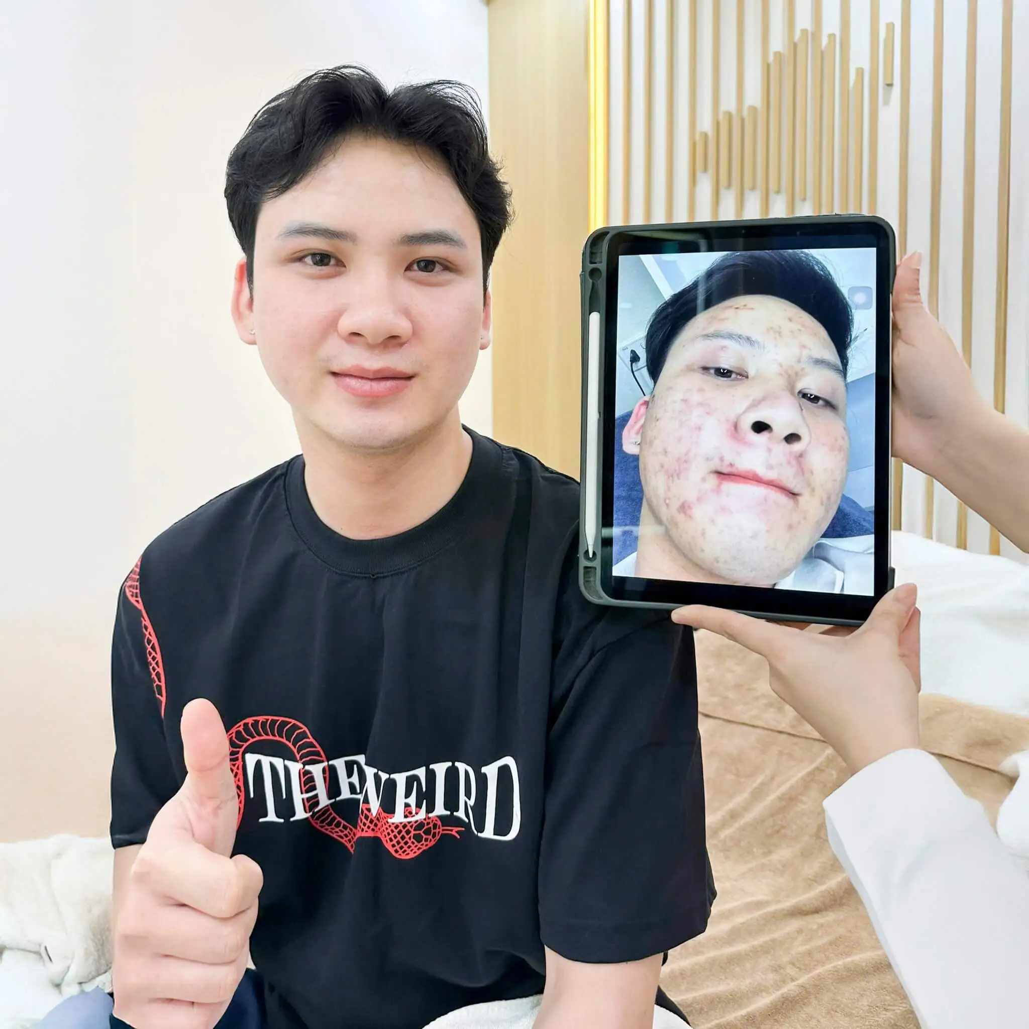 Sạch mụn sau 1 liệu trình ngắn