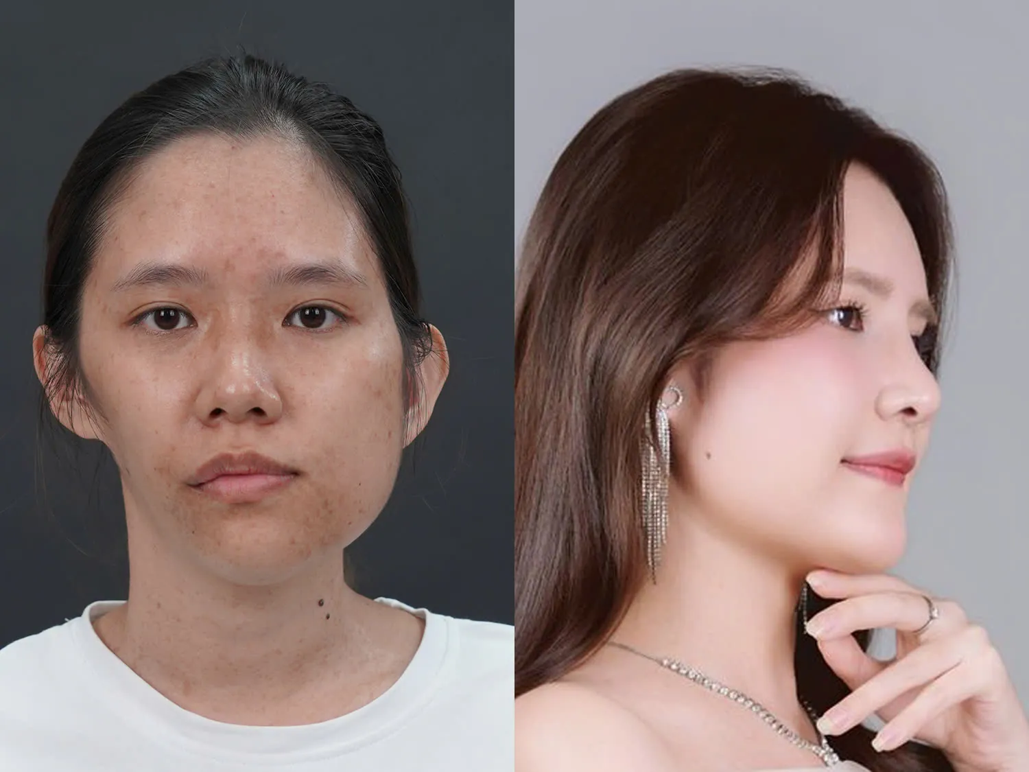 Võ Trần Bảo Ngọc trước và sau khi chỉnh hàm, nâng mũi, gương mặt cân đối và hài hòa