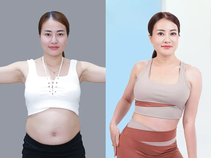 Vòng bụng ổn định sau khi hết sưng tấy sau 1 tháng hút mỡ