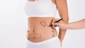 Sau hút mỡ bao lâu hết đau? Quá trình phục hồi và dấu hiệu biến chứng