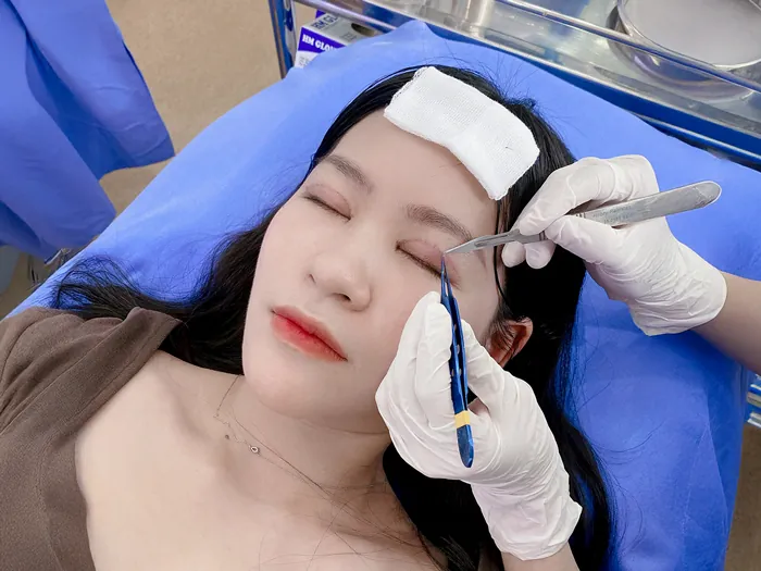 chi phí cắt mí trọn gói đã bao gồm cắt chỉ, khách hàng đi cắt chỉ không mất thêm tiền