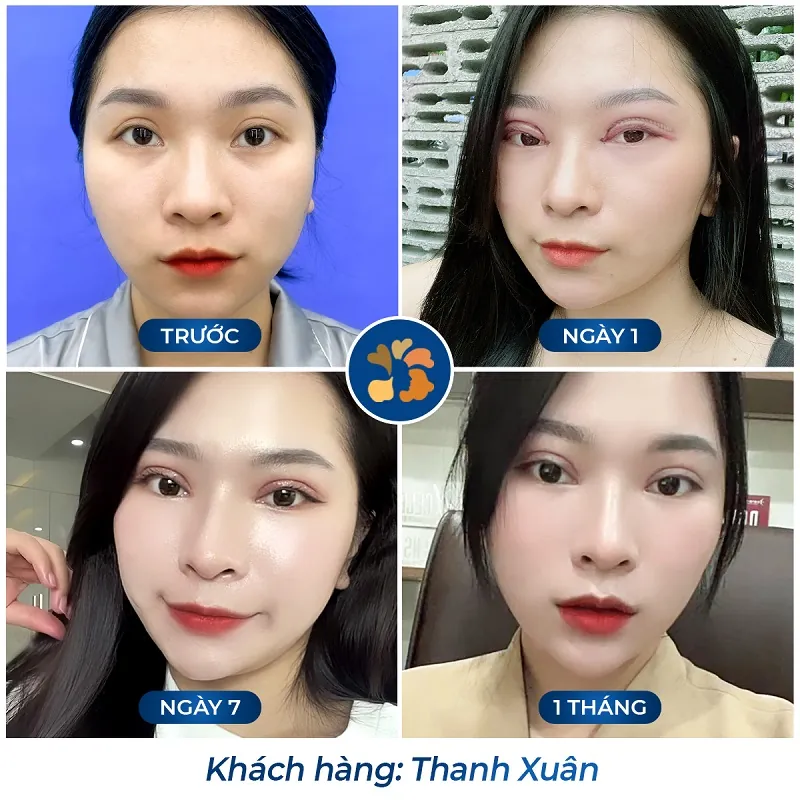 Sự thay đổi sắc tố và độ mềm mại của đường rạch mí qua từng giai đoạn trưởng thành của sẹo.