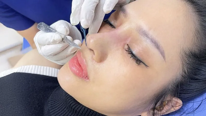 Kỹ thuật cắt chỉ và tháo nẹp sau nâng mũi 10 ngày đảm bảo không để lại sẹo.