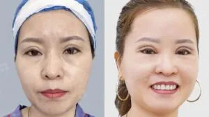 Cắt mí bị lệch: Nguyên nhân, bao lâu thì đều và khi nào cần sửa