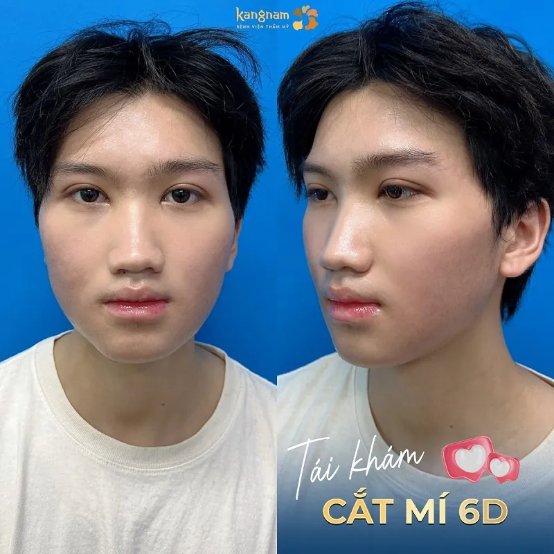 Lựa chọn dáng mí phù hợp với cấu trúc khuôn mặt là yếu tố then chốt giúp duy trì vẻ nam tính sau phẫu thuật.