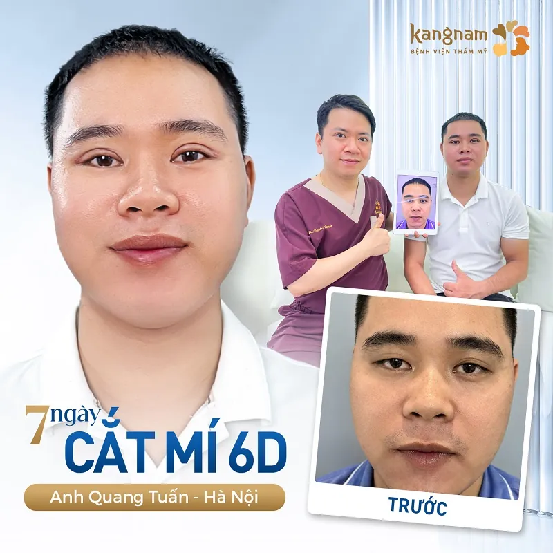 Cắt mí 6D giúp tạo nếp mí cân đối, nam tính cho nam giới