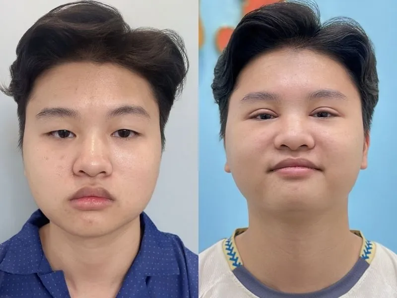 Nam giới có thể cắt mí để khắc phục tình trạng mí lót, mí ẩn