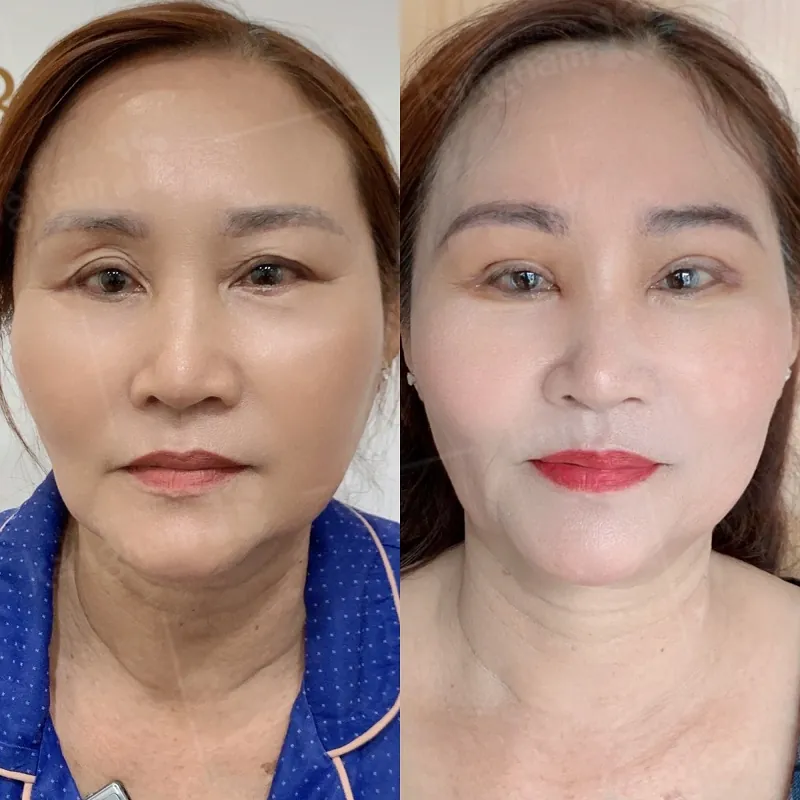 Da dư che khuất tầm nhìn của người lớn tuổi