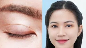 Cắt mí có cần lấy mỡ không