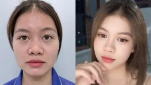 7 ngày thay đổi nếp mí của Diệu Yến tại Kangnam Hà Nội