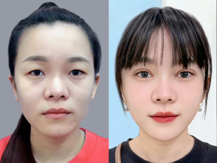 Mỗi công nghệ cắt mí có ưu điểm riêng, cắt mí Plasma là sự cân bằng giữa độ bền và tính tự nhiên.