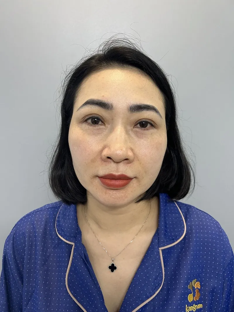 Mí mắt chị Quỳnh Mai gặp tình trạng sụp mí do lão hóa