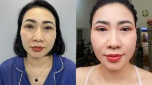 Khách hàng Quỳnh Mai cải thiện mí sụp tại Kangnam Hà Nội