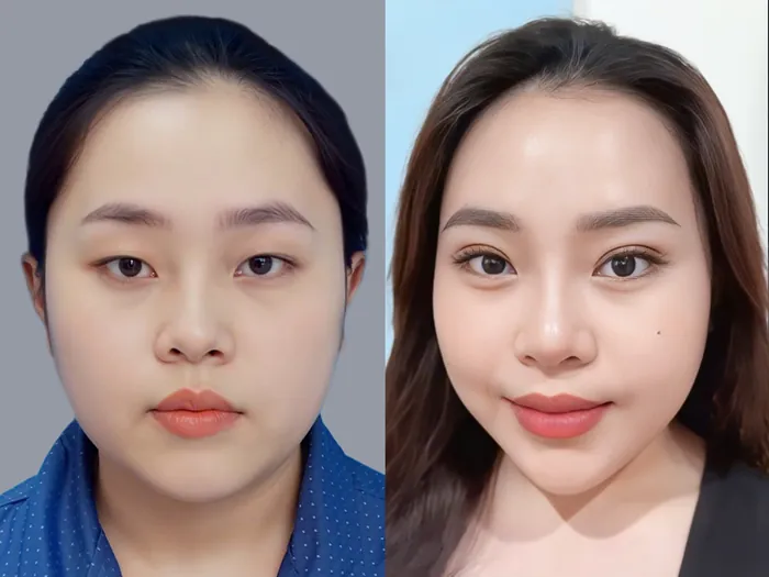 khách hàng cắt mí duy trì kết qura ổn định và lâu dài, gương mặt nét hơn