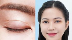 Cắt mí truyền thống