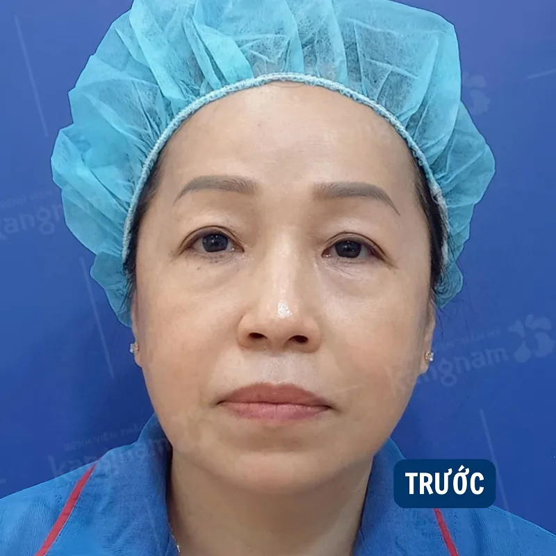 Tình trạng sụp mí nhiều mỡ thừa, da dư ở người lớn tuổi