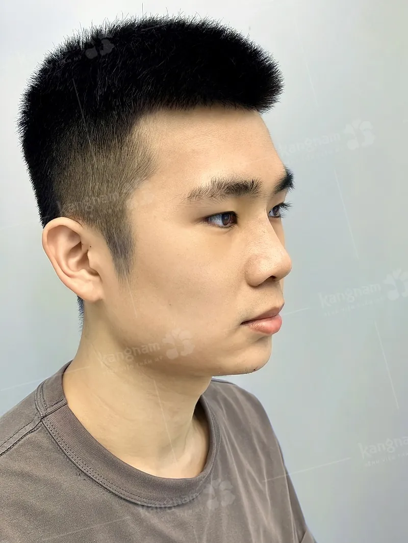 Sự hài hòa của nâng mũi L-line phiên bản Á Đông điều chỉnh, đảm bảo vẻ đẹp tự nhiên nhưng vẫn giữ được độ cao sang trọng.