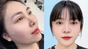 Dấu hiệu hồi phục sau cắt mí - Quá trình phục hồi chuẩn từng giai đoạn