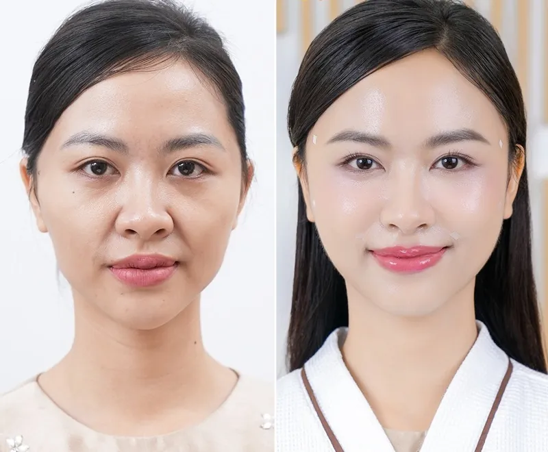 Căng da trẻ hóa, tái tạo nét xuân