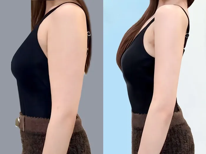 Giá hút mỡ bắp tay ở mỗi cơ sở là khác nhau dao động vài chục triệu đồng